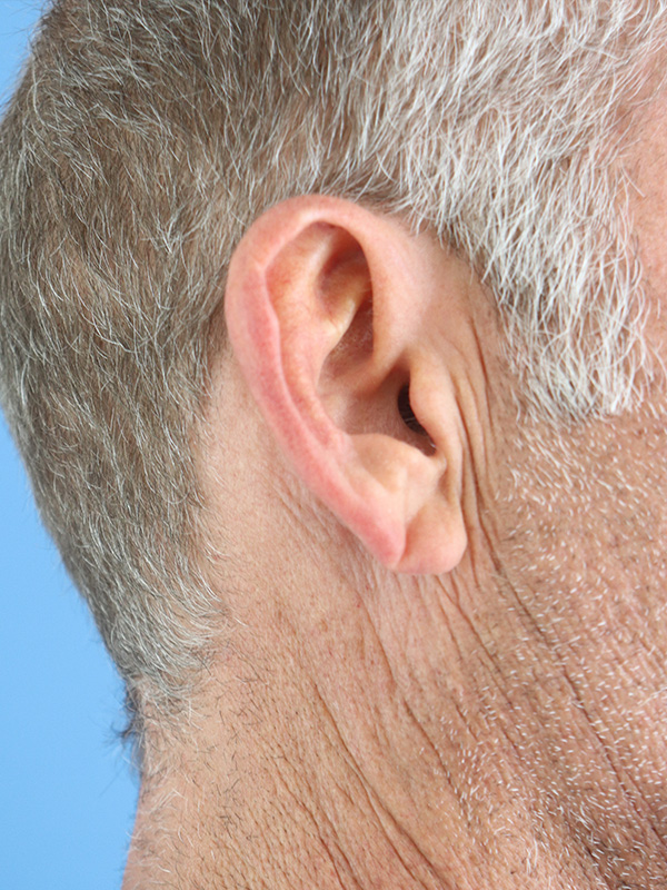 Earlobe Repair Before & After Gallery - Patient 362551 - Image 1