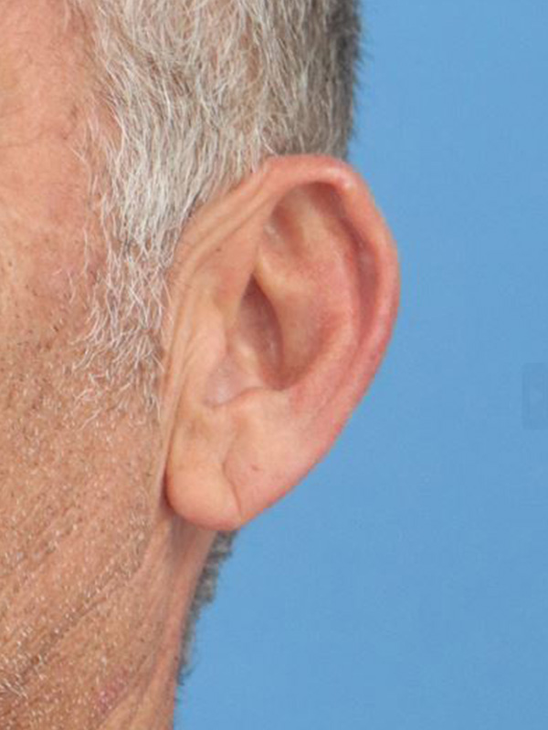 Earlobe Repair Before & After Gallery - Patient 362551 - Image 3