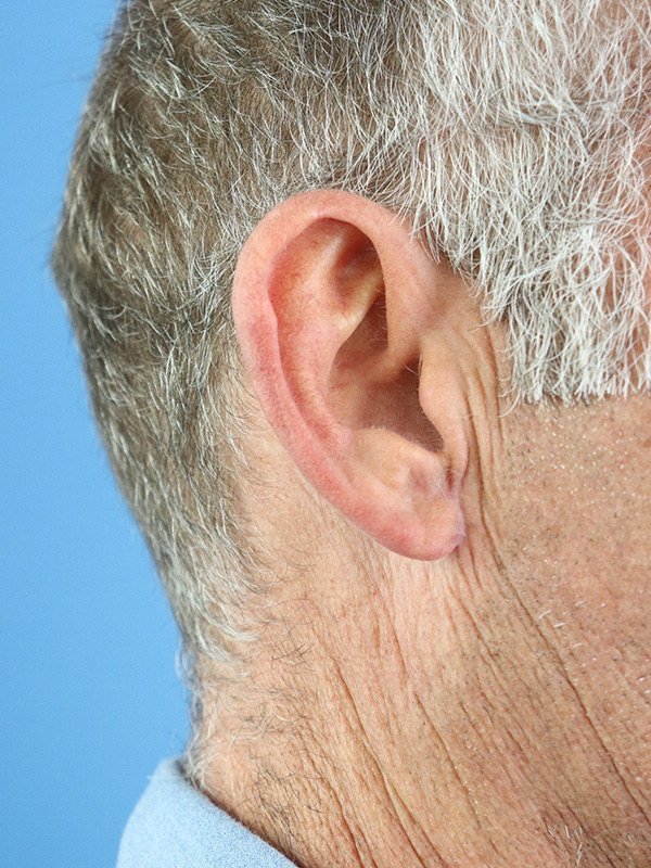 Earlobe Repair Before & After Gallery - Patient 362551 - Image 2