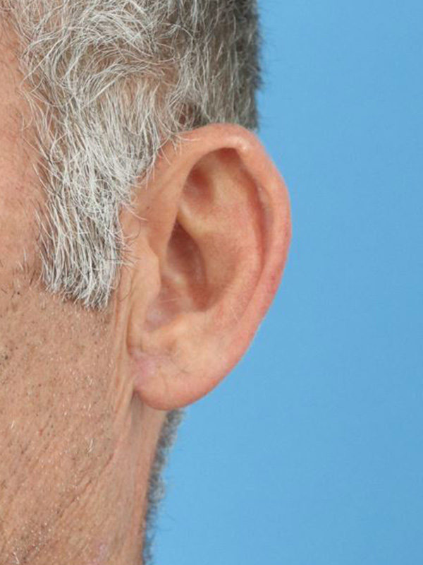 Earlobe Repair Before & After Gallery - Patient 362551 - Image 4