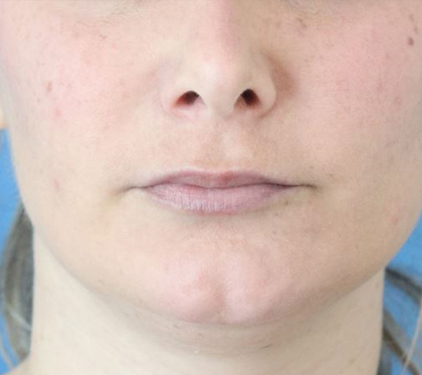 Lip Lift Before & After Gallery - Patient 917303 - Image 1