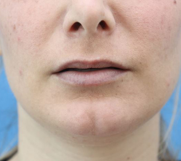 Lip Lift Before & After Gallery - Patient 917303 - Image 3