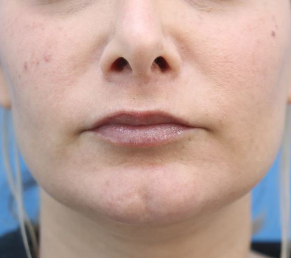 Lip Lift Before & After Gallery - Patient 917303 - Image 2