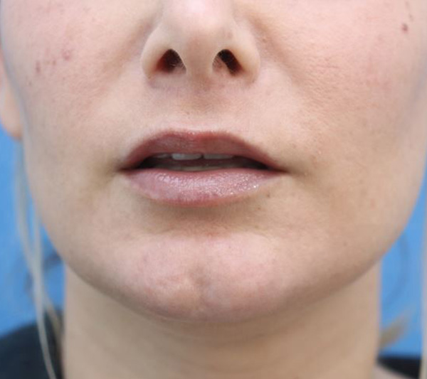 Lip Lift Before & After Gallery - Patient 917303 - Image 4