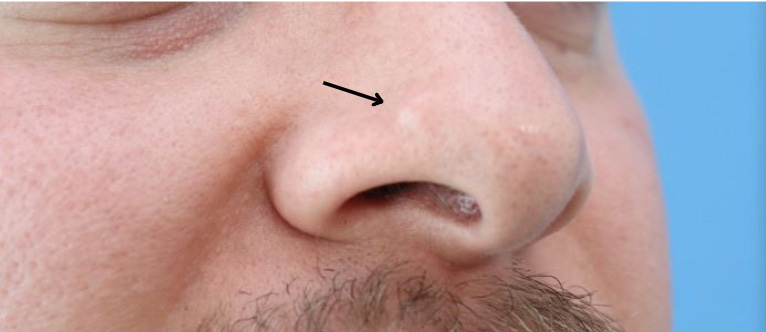 Mole Removal Before & After Gallery - Patient 293146 - Image 1